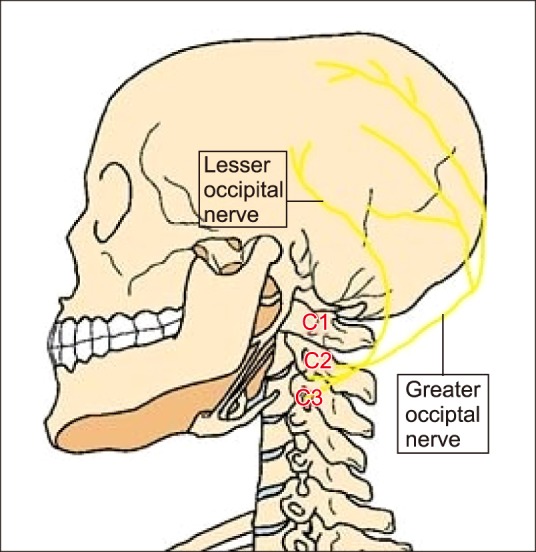 Schéma du nerf d’Arnold illustrant une névralgie d’Arnold responsable de douleur à l’arrière du crâne et migraine cervicale